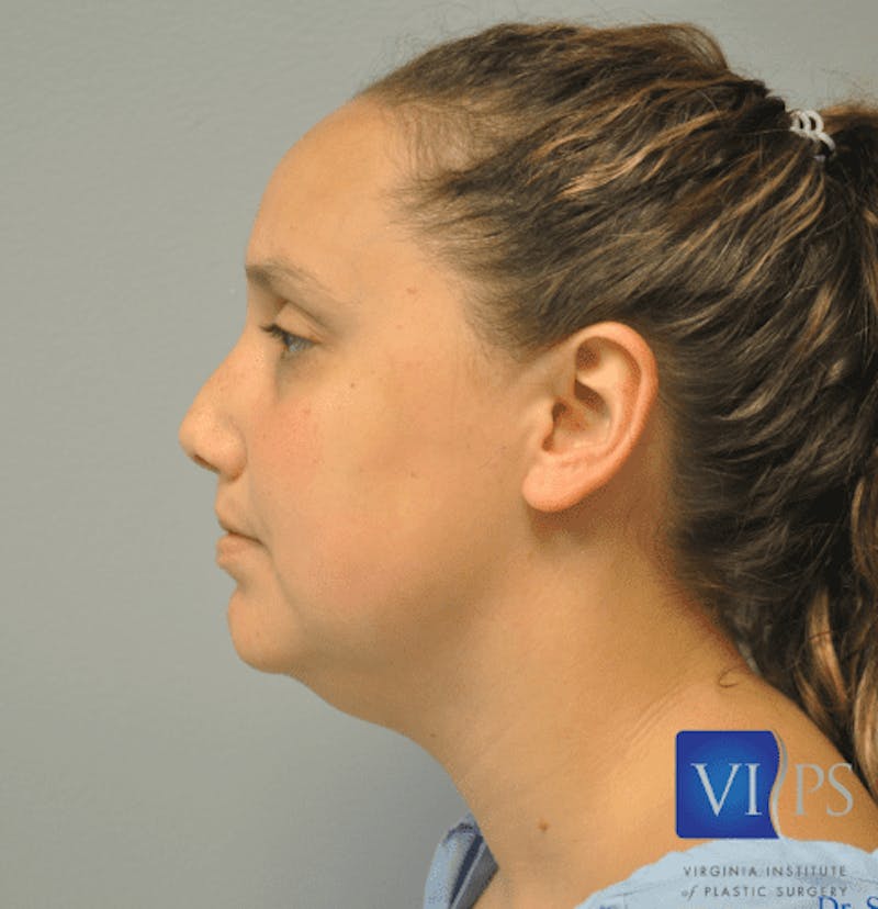 JPlasma Before & After Gallery - Patient 55345074 - Image 9