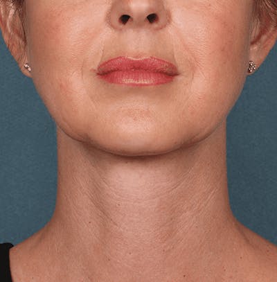 Kybella Before & After Gallery - Patient 55345075 - Image 2