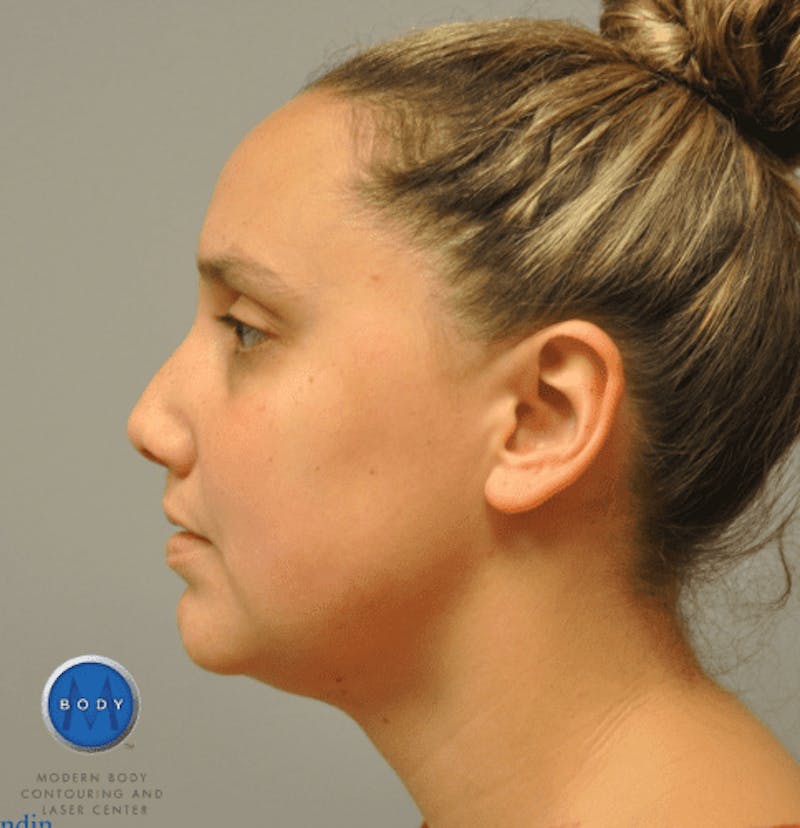 JPlasma Before & After Gallery - Patient 55345074 - Image 10