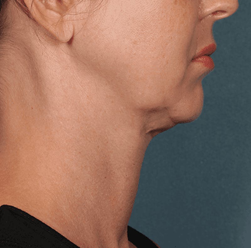 Kybella Before & After Gallery - Patient 55345075 - Image 3