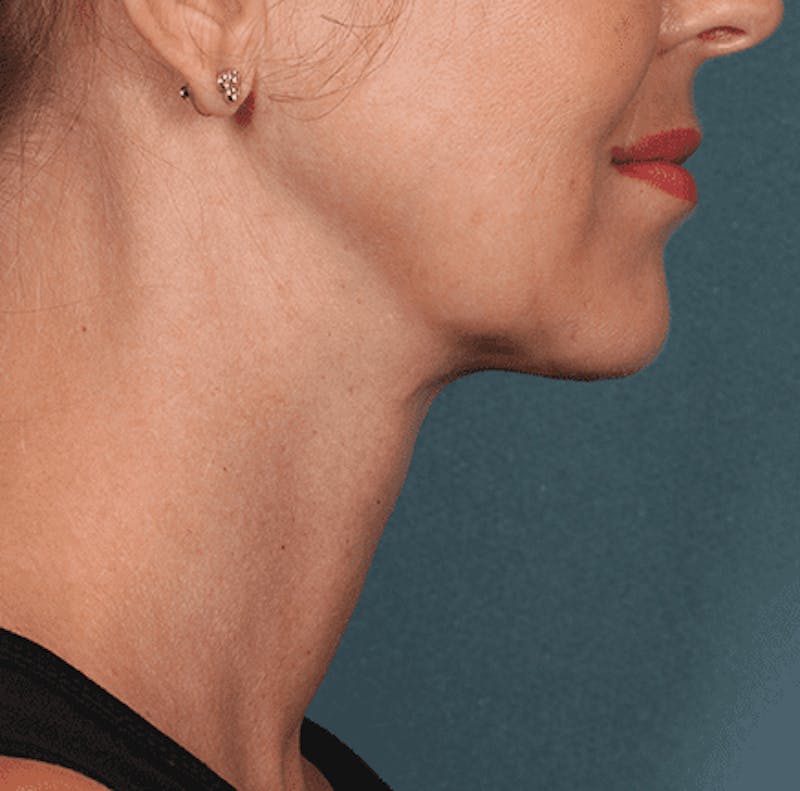 Kybella Before & After Gallery - Patient 55345075 - Image 4