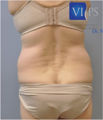 JPlasma Before & After Gallery - Patient 55345078 - Image 1