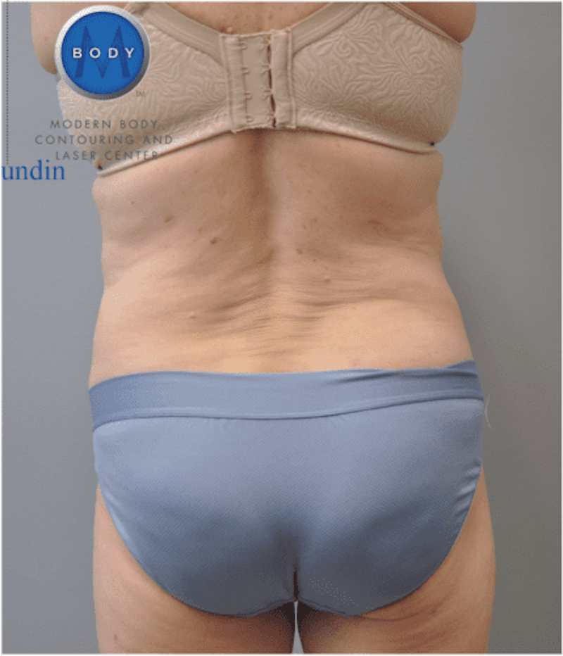 JPlasma Before & After Gallery - Patient 55345078 - Image 2