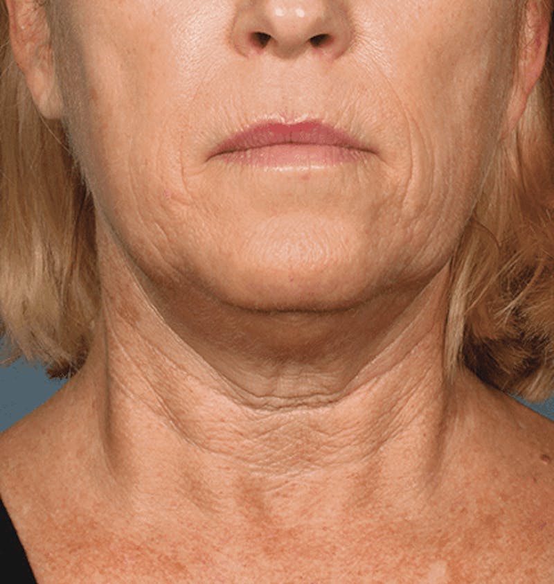 Kybella Before & After Gallery - Patient 55345077 - Image 1