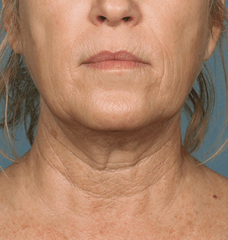 Kybella Before & After Gallery - Patient 55345077 - Image 2