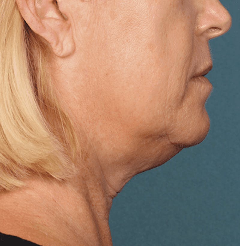 Kybella Before & After Gallery - Patient 55345077 - Image 3