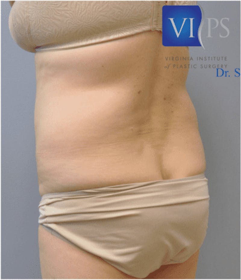 JPlasma Before & After Gallery - Patient 55345078 - Image 5