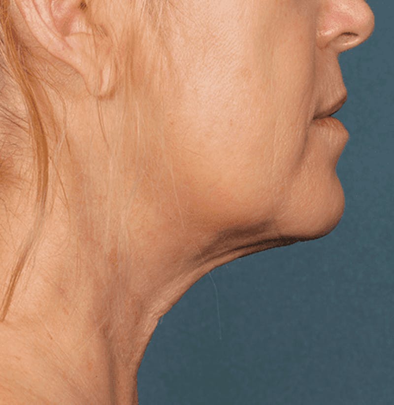 Kybella Before & After Gallery - Patient 55345077 - Image 4