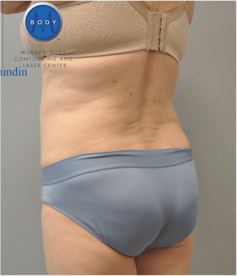 JPlasma Before & After Gallery - Patient 55345078 - Image 6