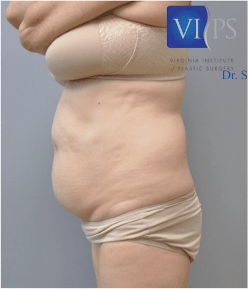 JPlasma Before & After Gallery - Patient 55345078 - Image 7