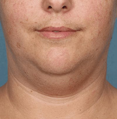 Kybella Before & After Gallery - Patient 55345080 - Image 1