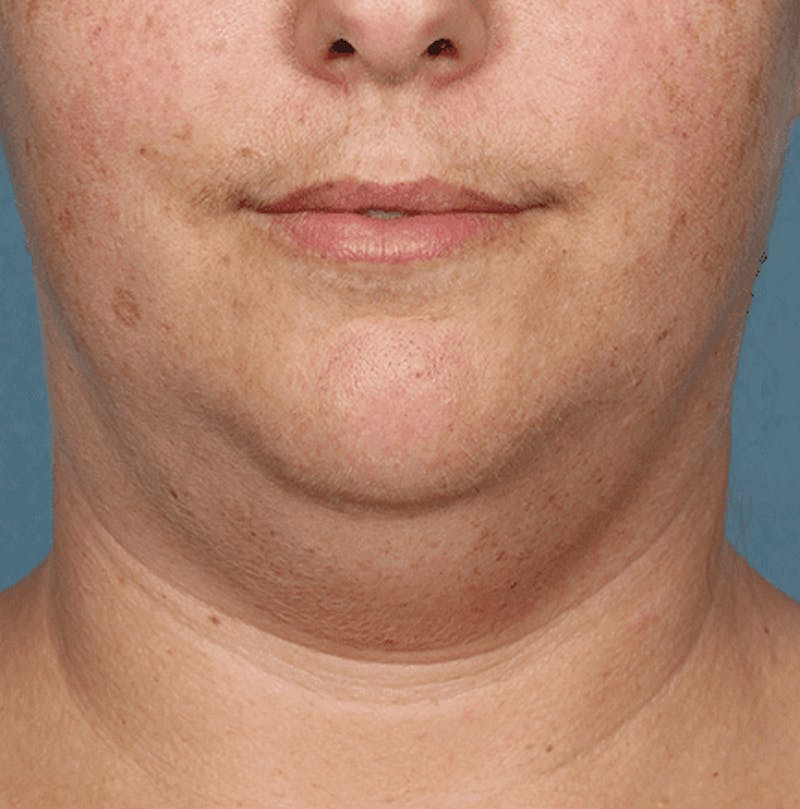 Kybella Before & After Gallery - Patient 55345080 - Image 1