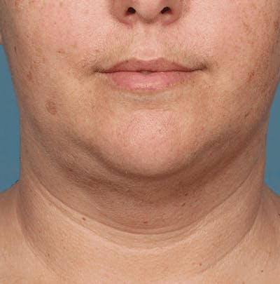 Kybella Before & After Gallery - Patient 55345080 - Image 2