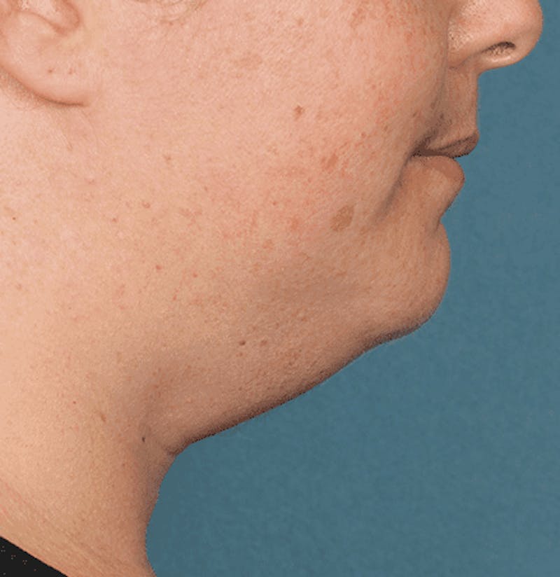 Kybella Before & After Gallery - Patient 55345080 - Image 3