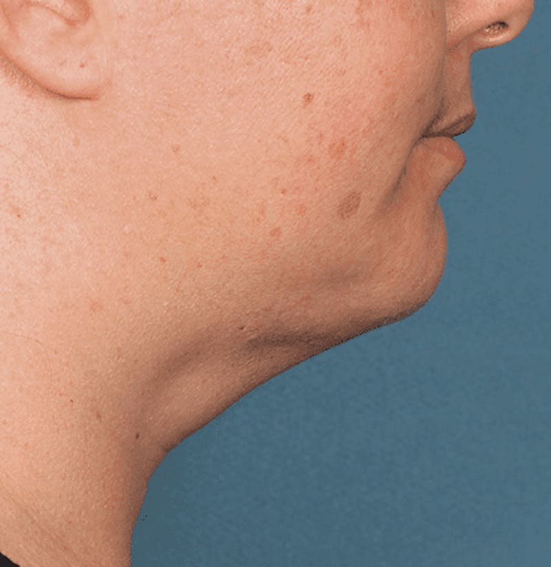 Kybella Before & After Gallery - Patient 55345080 - Image 4