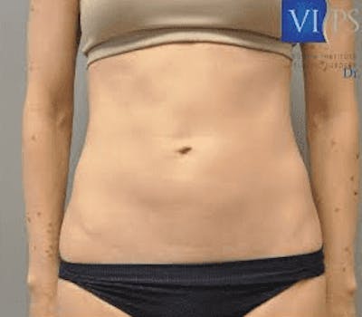 JPlasma Before & After Gallery - Patient 55345083 - Image 1