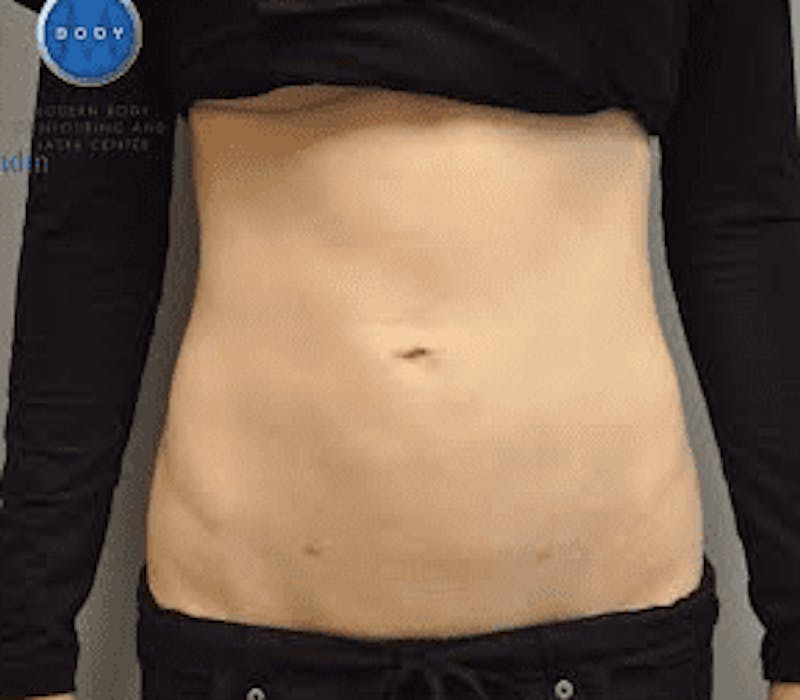 JPlasma Before & After Gallery - Patient 55345083 - Image 2