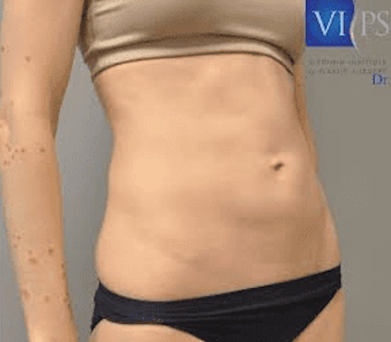 JPlasma Before & After Gallery - Patient 55345083 - Image 3