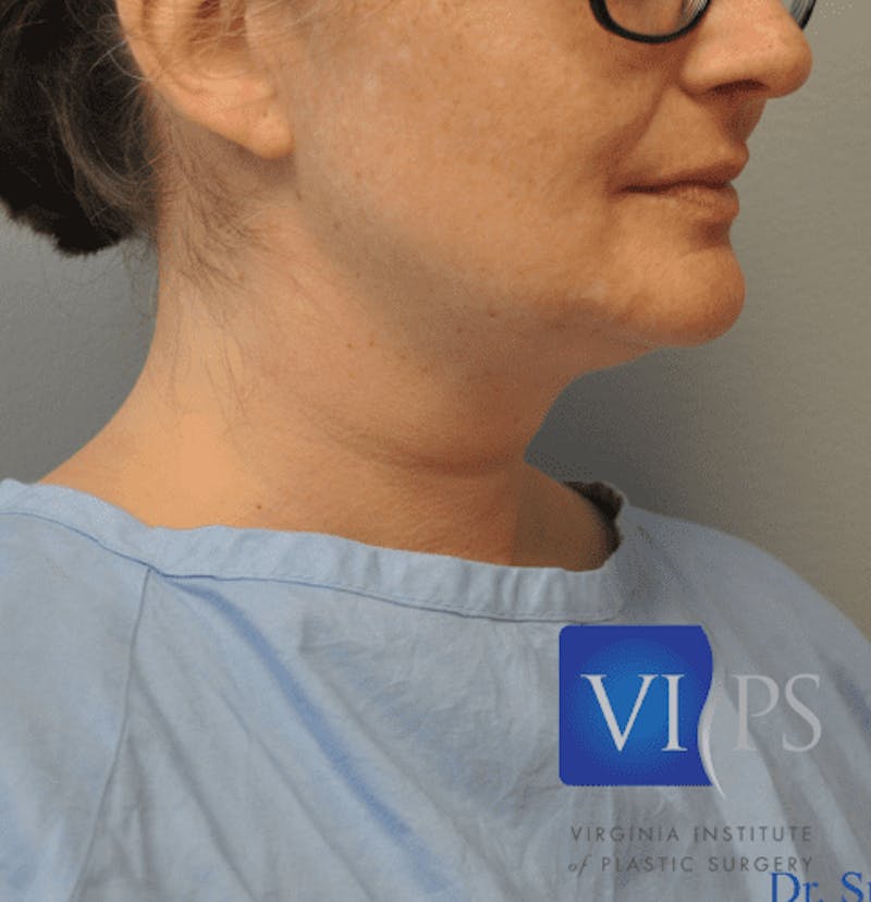 JPlasma Before & After Gallery - Patient 55345084 - Image 3
