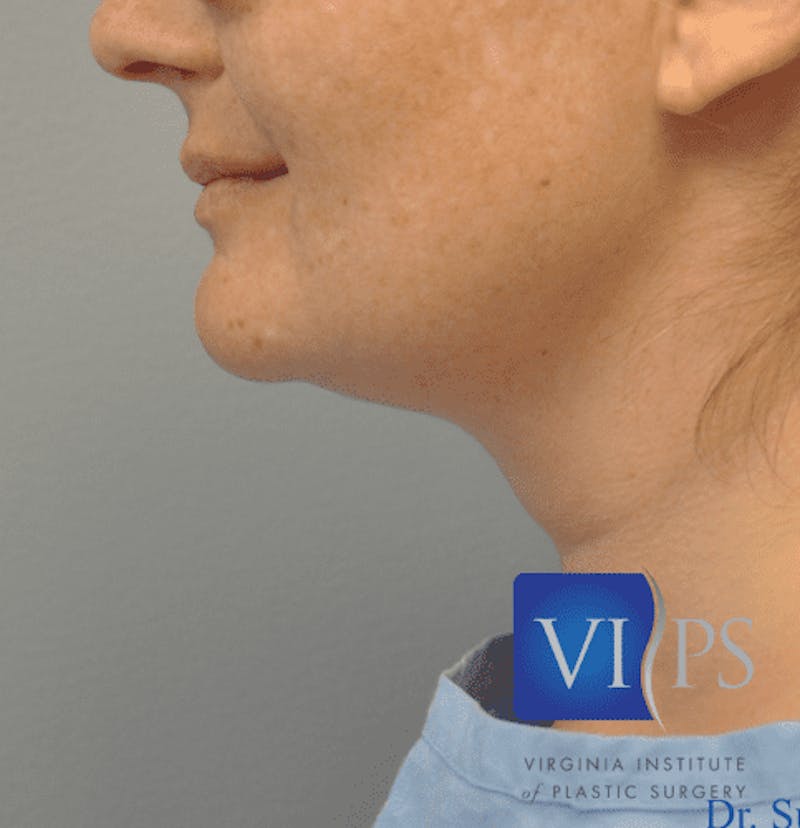 JPlasma Before & After Gallery - Patient 55345084 - Image 5