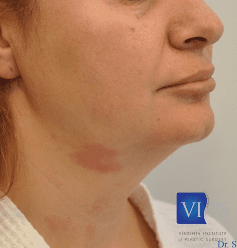 JPlasma Before & After Gallery - Patient 55345089 - Image 3
