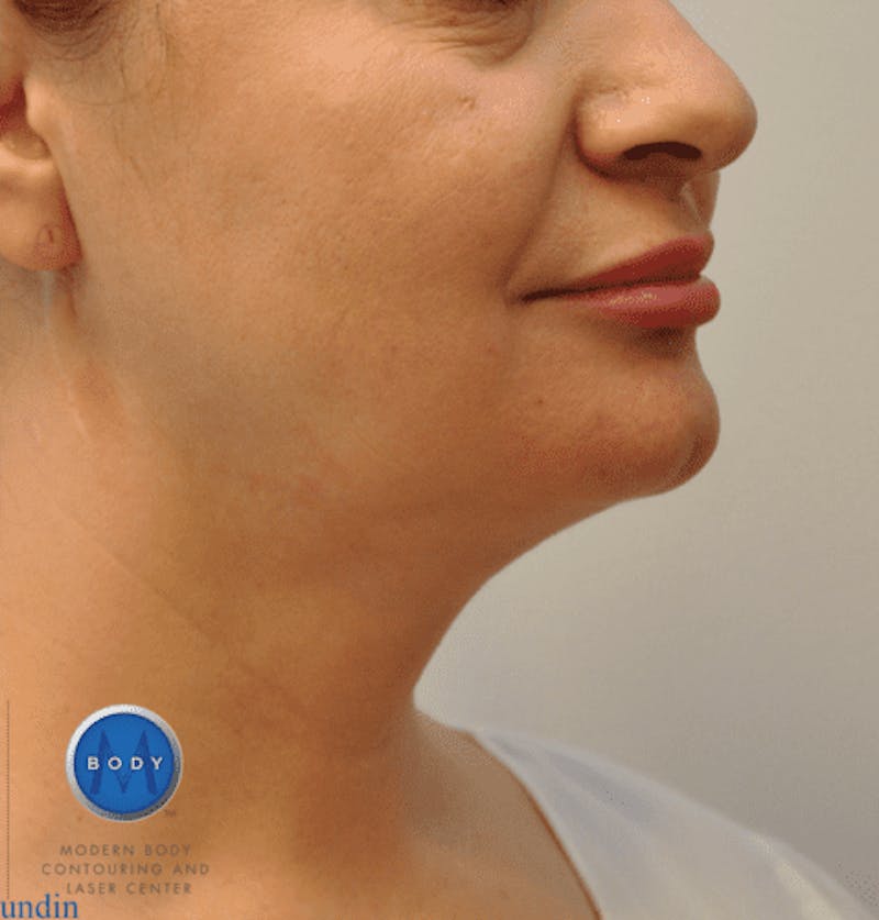 JPlasma Before & After Gallery - Patient 55345089 - Image 4