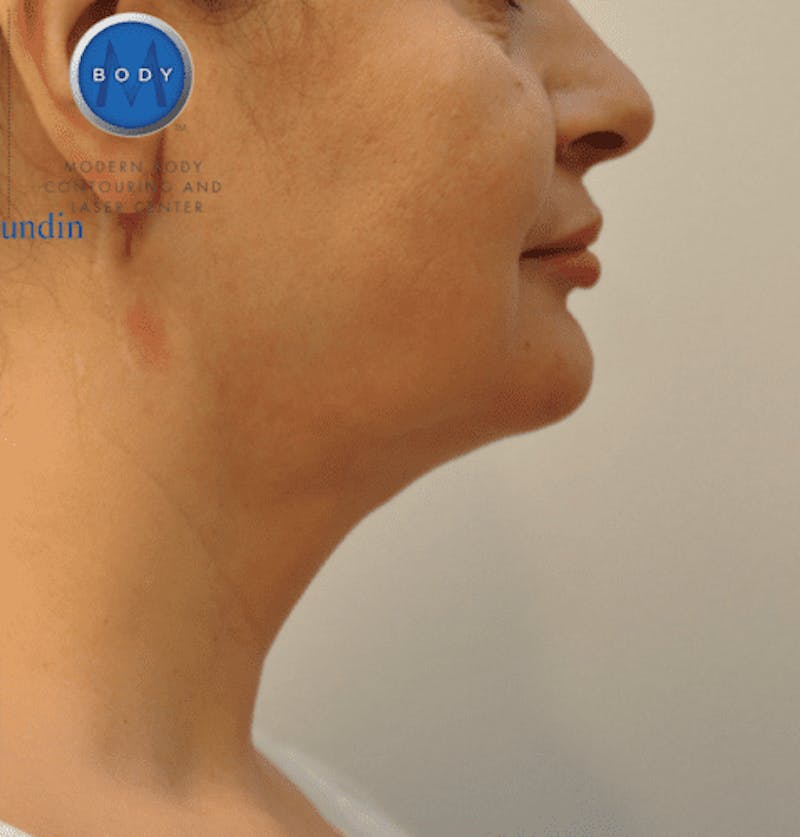JPlasma Before & After Gallery - Patient 55345089 - Image 6