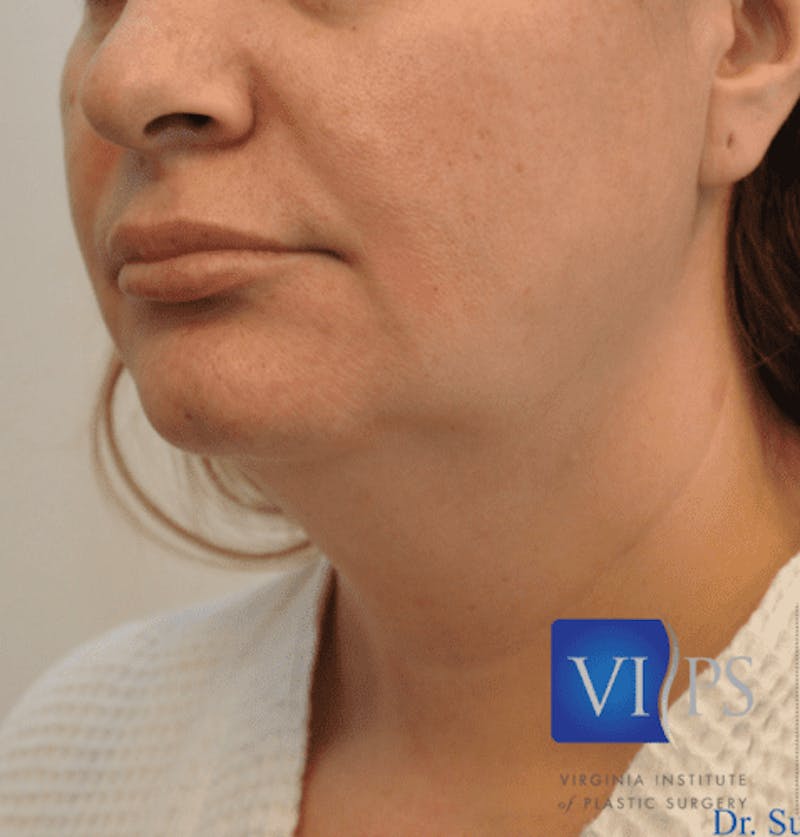 JPlasma Before & After Gallery - Patient 55345089 - Image 7