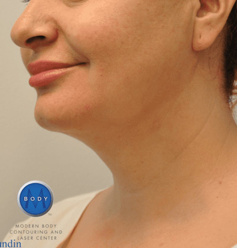 JPlasma Before & After Gallery - Patient 55345089 - Image 8