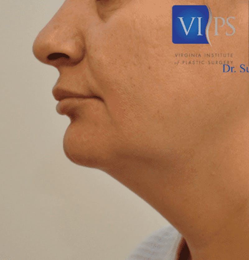 JPlasma Before & After Gallery - Patient 55345089 - Image 9