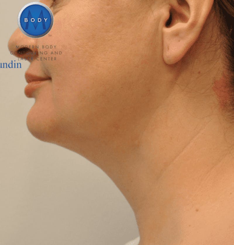 JPlasma Before & After Gallery - Patient 55345089 - Image 10
