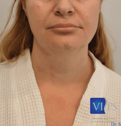 JPlasma Before & After Gallery - Patient 55345093 - Image 1