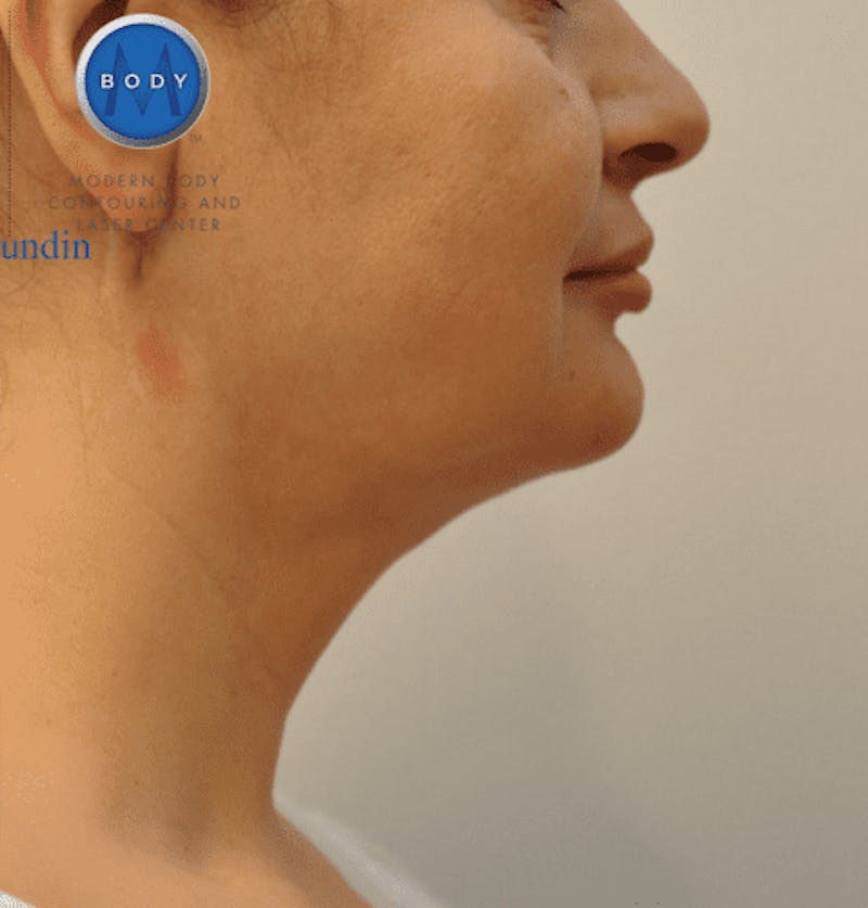 JPlasma Before & After Gallery - Patient 55345093 - Image 6