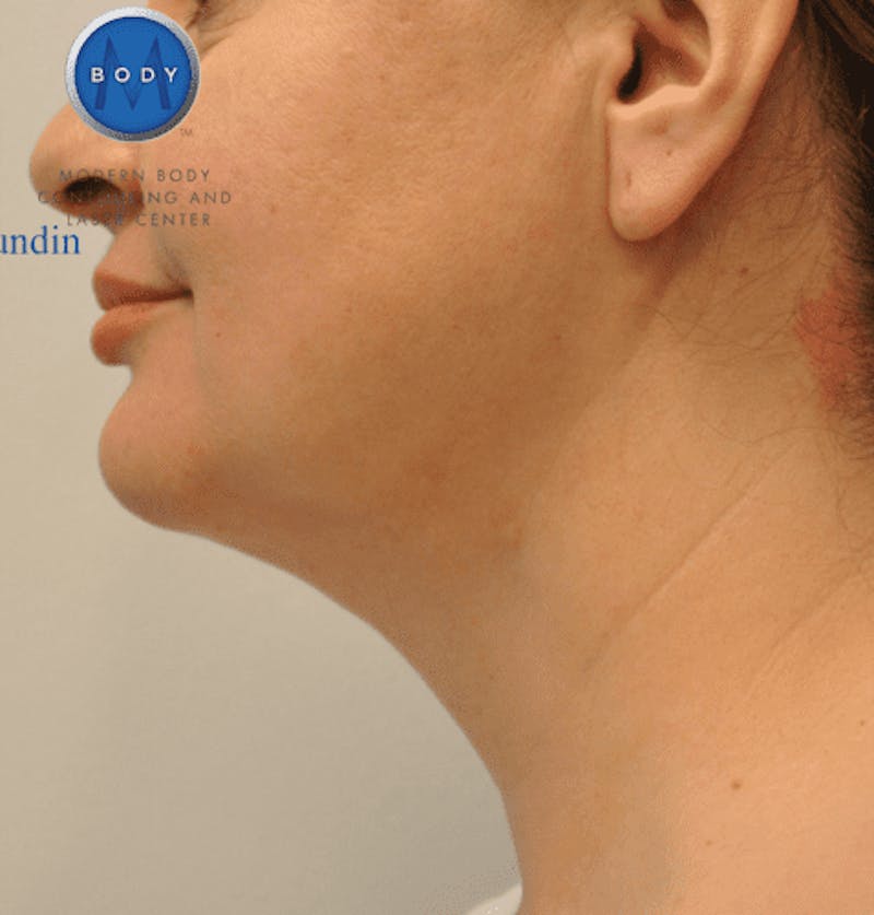 JPlasma Before & After Gallery - Patient 55345093 - Image 10