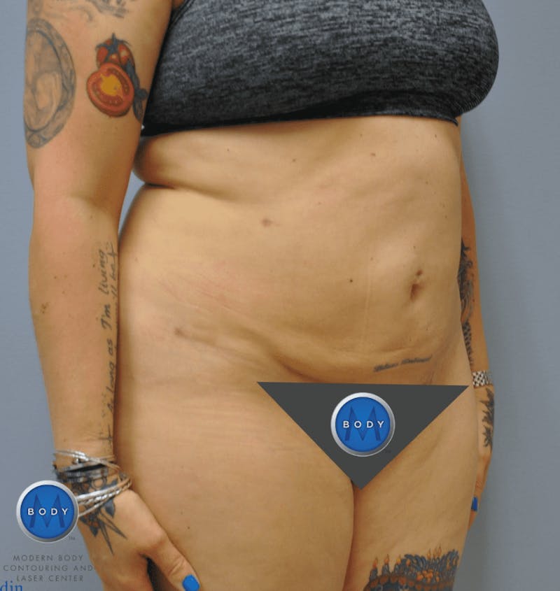 JPlasma Before & After Gallery - Patient 55345100 - Image 4