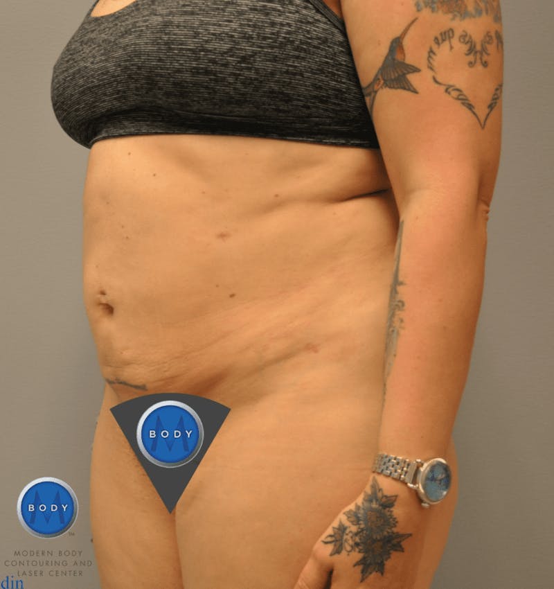 JPlasma Before & After Gallery - Patient 55345100 - Image 6