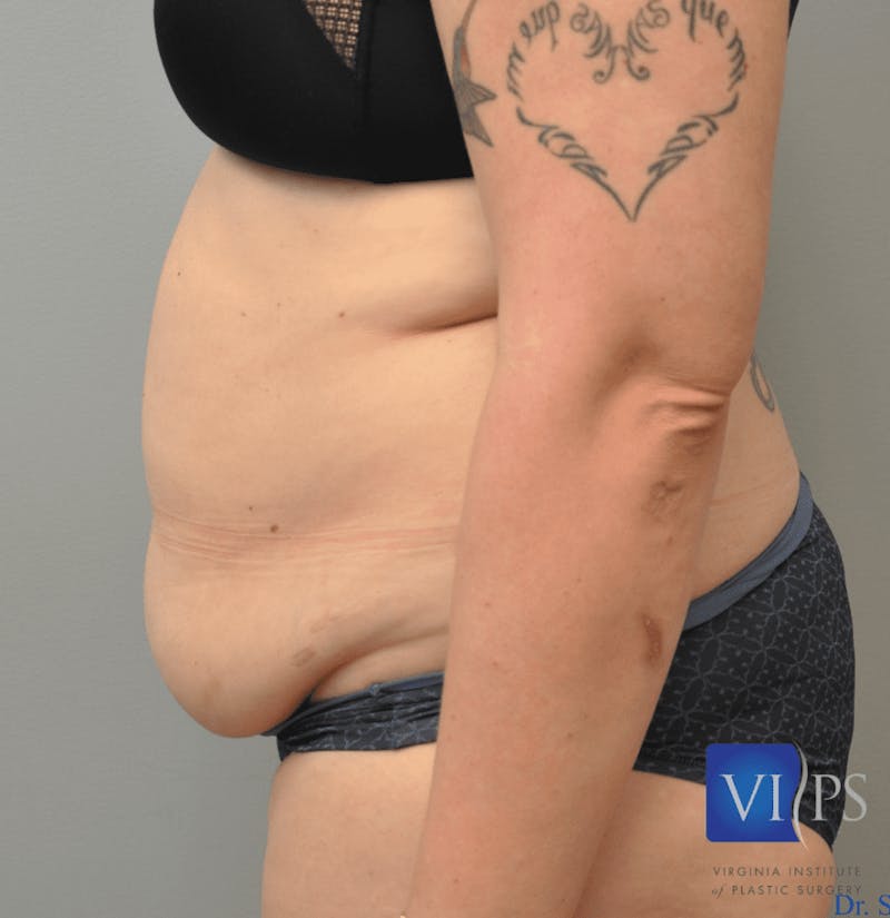 JPlasma Before & After Gallery - Patient 55345100 - Image 7