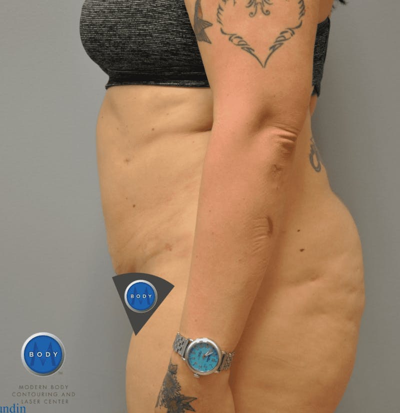 JPlasma Before & After Gallery - Patient 55345100 - Image 8