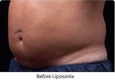Liposonix Before & After Gallery - Patient 55345103 - Image 1