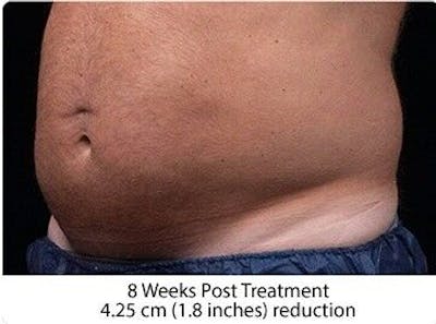 Liposonix Before & After Gallery - Patient 55345103 - Image 2