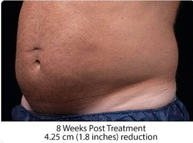Liposonix Before & After Gallery - Patient 55345103 - Image 2