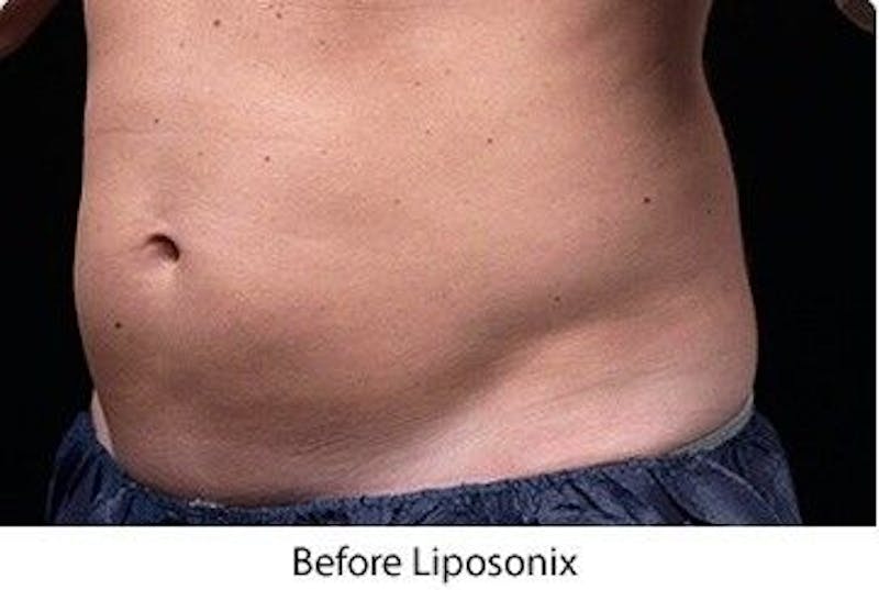 Liposonix Before & After Gallery - Patient 55345105 - Image 1