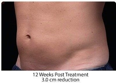 Liposonix Before & After Gallery - Patient 55345105 - Image 2