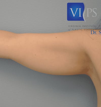 JPlasma Before & After Gallery - Patient 55345109 - Image 1