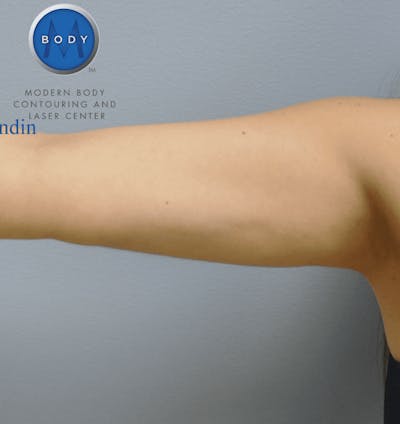 JPlasma Before & After Gallery - Patient 55345109 - Image 2