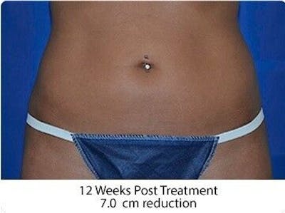 Liposonix Before & After Gallery - Patient 55345106 - Image 2