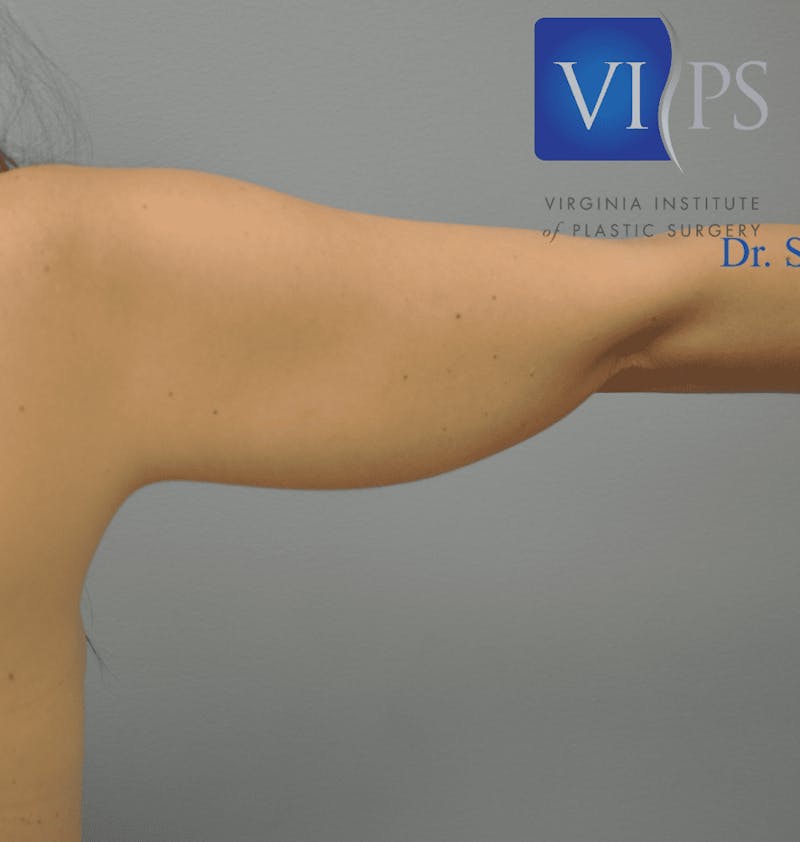 JPlasma Before & After Gallery - Patient 55345109 - Image 3