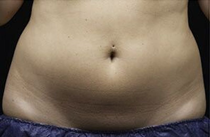 Liposonix Before & After Gallery - Patient 55345112 - Image 1