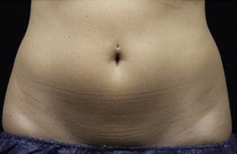 Liposonix Before & After Gallery - Patient 55345112 - Image 2