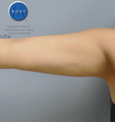JPlasma Before & After Gallery - Patient 55345115 - Image 2